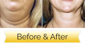 Cheryl's before and after